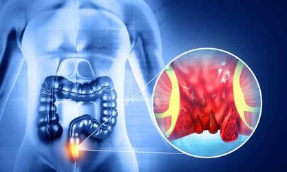 Hemorrhoids Hemorrhoids