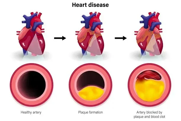 myocardial infarction myocardial infarction